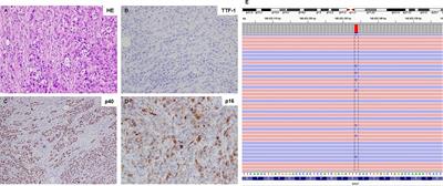 Challenges in the treatment of BRAF K601E-mutated lung carcinoma: a case report of rapid response and resistance to dabrafenib and trametinib